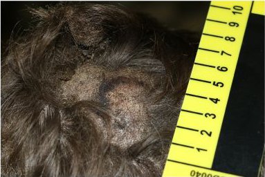 zranění světlicí 1