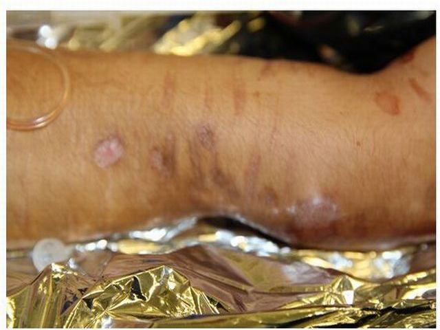 jizvy na ruce zraněného muže